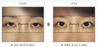 두한성형외과 쌍커풀 재수술 - 짝눈 눈매교정, 가성 안검하수 교정과 뒤밑트임 관련 이미지 55