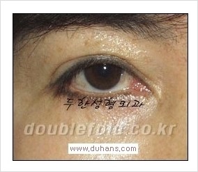[두한성형외과 경쟁력 쌍꺼풀 재수술] - [Dr. 컬럼 - "재수술의 이상적인 목표"] 관련 이미지 12