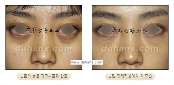 [두한성형외과 상큼하고 환한 눈매완성] - [눈밑 미세지방이식 ①] 관련 이미지 13