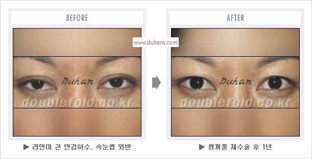 [두한성형외과 경쟁력 눈성형] - [나에게 맞는 어울리는 쌍꺼풀 라인] 관련 이미지 15