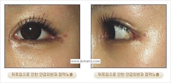 [두한성형외과 경쟁력 쌍꺼풀 재수술, 극한 눈재수술] - [뒤트임 수술의 부작용 안내] 관련 이미지 5