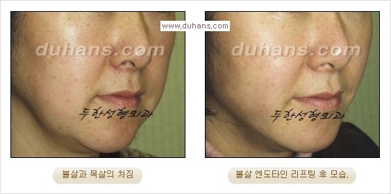 [두한성형외과 경쟁력 주름성형] - [눈썹거상, 앞볼처짐 개선의 엔도타인 리프팅] 관련 이미지 13