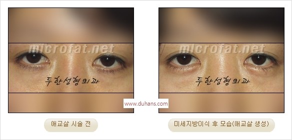 [두한성형외과 경쟁력 미세지방이식] - [애교살 필러 시술의 부작용 교정] 관련 이미지 10