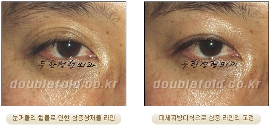 [두한성형외과 눈재수술] - [재수술 방법들] 관련 이미지 28