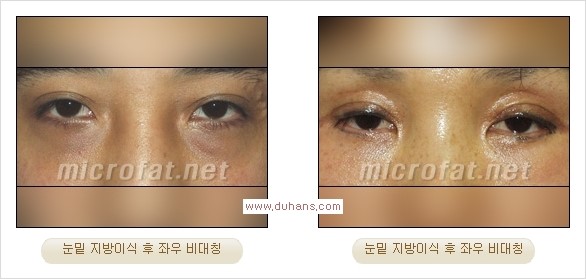 [두한성형외과 경쟁력 미세지방이식] - [미세지방이식, 자가지방이식, 지방이식, 지방주입에 대한 잘못된 정보] 관련 이미지 19