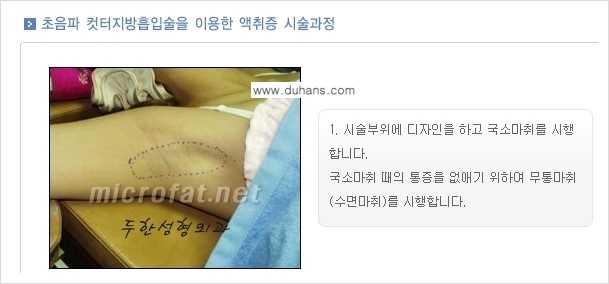 [두한성형외과 경쟁력 액취증, 다한증 치료] - [겨드랑이의 참기 힘든 냄새와 땀 치료 - 초음파 컷터지방흡입 + 리포셋 소파흡입술] 관련 이미지 14