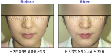[Duhan Plastic Surgery Clinic Aesthetic Procedures] - [Square Jaw Botox] image 18