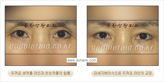 [두한성형외과 NO.1 눈성형] - [함몰된(꺼진) 눈꺼풀에서 쌍꺼풀 라인 교정 2.] 관련 이미지 18