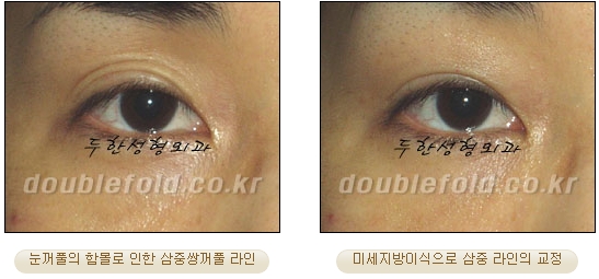 두한성형외과 쌍커풀재수술 - 삼중 쌍커풀 라인 교정 관련 이미지 33