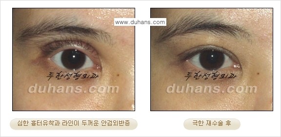 [두한성형외과 성형 FOCUS] - [정상적인 눈매로의 복원 극한재수술 경우 ②] 관련 이미지 1
