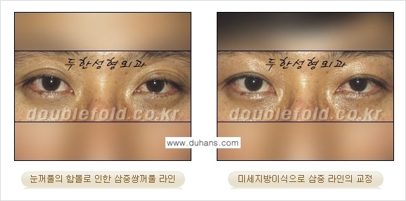 [두한성형외과 경쟁력 눈성형] - [미세지방이식으로 삼중 라인의 교정 방법 안내] 관련 이미지 3
