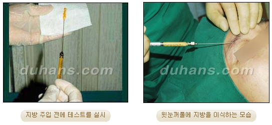 [Duhan Plastic Surgery Micro Fat Grafting] - [Upper Eyelids] image 6
