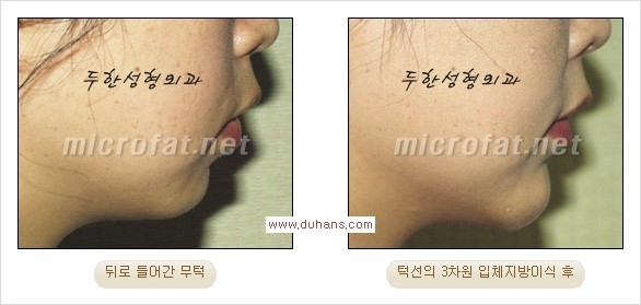 [두한성형외과 경쟁력 미세지방이식] - [부드럽고 아름다운 얼굴윤곽선 턱(하악부) 미세지방이식 안내] 관련 이미지 24