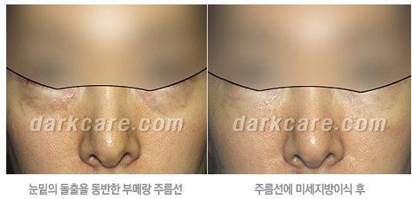 [두한성형외과 눈밑성형] - [무흉터 눈밑지방제거] 관련 이미지 10