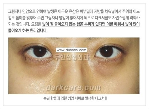 [두한성형외과 경쟁력 다크써클 교정] - [다크써클의 원인 안내] 관련 이미지 5