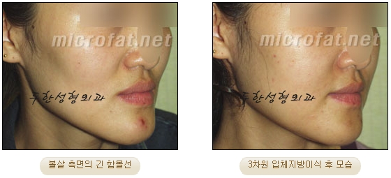 얼굴지방이식 두한성형외과 - 볼지방이식 관련 이미지 26