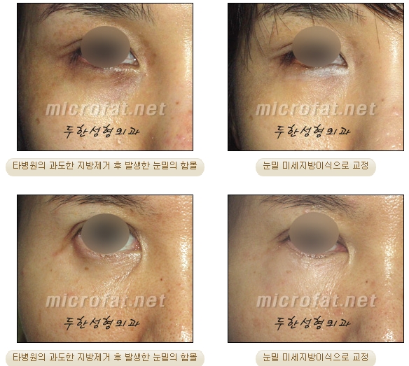 두한성형외과 눈밑성형 - 눈밑지방제거, 눈밑주름, 눈밑지방재배치 관련 이미지 50