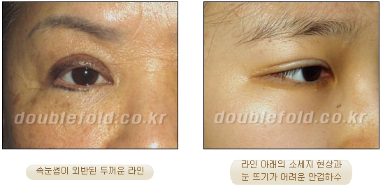 [두한성형외과 쌍수] - [재수술 실패의 원인, 재수술의 성공 요건] 관련 이미지 2