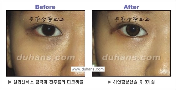 [두한성형외과의 상큼하고 환한 젊은 눈매완성] - [하안검 성형술 ②] 관련 이미지 5