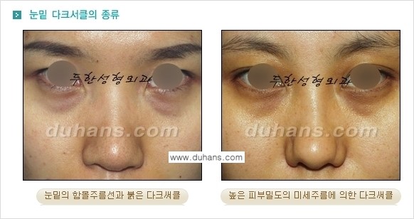 [두한성형외과 경쟁력 미세지방이식] - [다크써클 & 눈밑주름 미세지방이식 1.] 관련 이미지 2