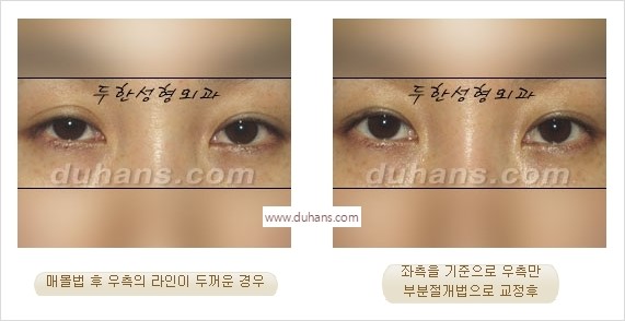 [두한성형외과 경쟁력 눈성형] - [나에게 맞는 어울리는 쌍꺼풀 라인] 관련 이미지 31