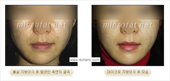 [두한성형외과 경쟁력 미세지방이식] - [미세지방이식 부작용 종류와 교정방법 안내] 관련 이미지 2