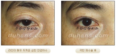 [Special Double Eyelid Revision Surgery at Duhan Plastic Surgery] - [Restorative Surgery for Damaged Double Eyelid Eye Shape] image 14