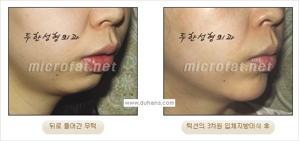 ⁠⁠[두한성형외과 경쟁력 미세지방이식] - [턱 미세지방이식 - 안면윤곽 교정 안내] 관련 이미지 24