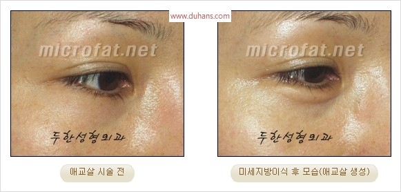 ​﻿[두한성형외과 경쟁력 지방이식] - [눈밑 애교살 시술을 위한 미세지방이식] 관련 이미지 21