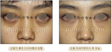 두한성형외과 눈밑성형 - 눈밑지방제거, 눈밑주름, 눈밑지방재배치 관련 이미지 72