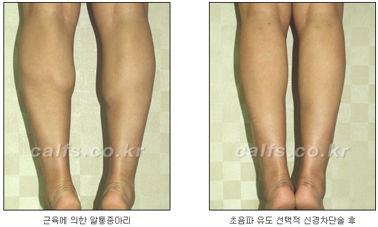 ​[두한성형외과 종아리성형] - [나에게 맞는 종아리시술] 관련 이미지 9