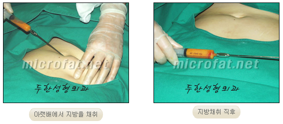 ​[두한성형외과 지방이식] - [애교살] 관련 이미지 3