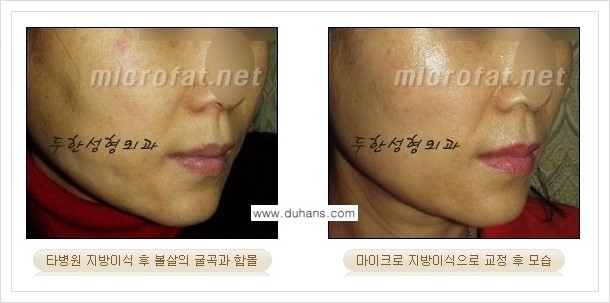 [두한성형외과 경쟁력 볼살지방이식] - [타병원 지방이식 후 - 굴곡이 발생한 경우, 과주입으로 인해 볼살이 불룩한 경우 안내] 관련 이미지 5