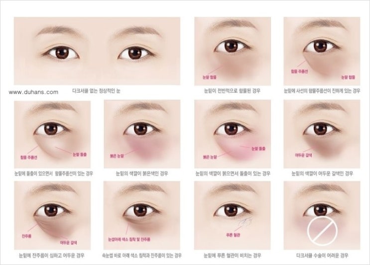 ​☞ [두한성형외과] - [다크써클 클리닉의 핵심 솔루션  5 STEP 을 소개합니다.]☜ 관련 이미지 3