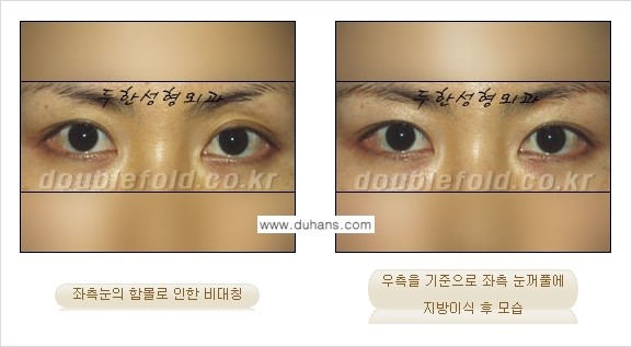 [두한성형외과 NO.1 눈성형] - [함몰된(꺼진) 눈꺼풀에서 쌍꺼풀 라인 교정 3.] 관련 이미지 2