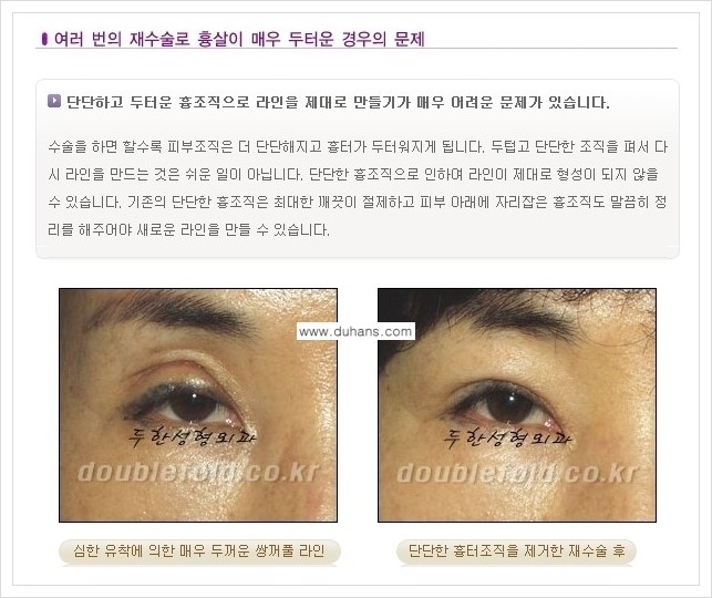 [두한성형외과 경쟁력 쌍꺼풀 재수술(극한 재수술)] - [쌍꺼풀 재수술에서 극복해야 할 여러 가지 상황과 문제점들 안내] 관련 이미지 3