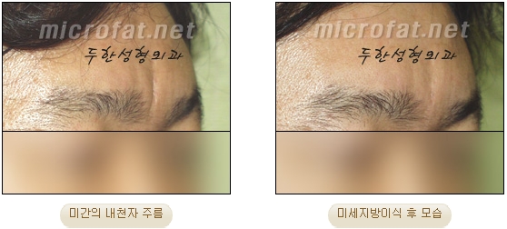 [두한성형외과 자가지방이식] - [미간주름] 관련 이미지 17
