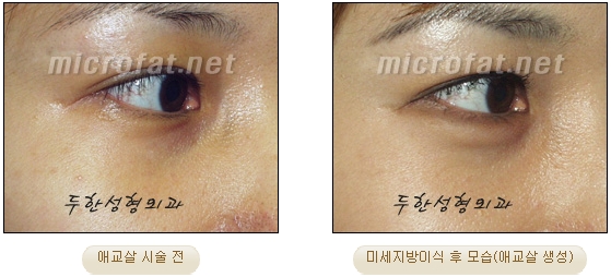 Duhan Plastic Surgery Under-Eye Surgery - Correction with Fat Grafting After Aegyo-Sal Filler image 32