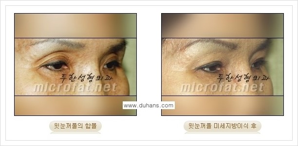 ⁠[두한성형외과 경쟁력 미세지방이식] - [상표등록 "Col-fat(콜펫) 지방이식"으로 교정이 가능한 부위] 관련 이미지 6
