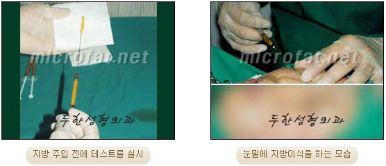 [두한성형외과 지방이식] - [다크서클, 눈밑주름] 관련 이미지 10