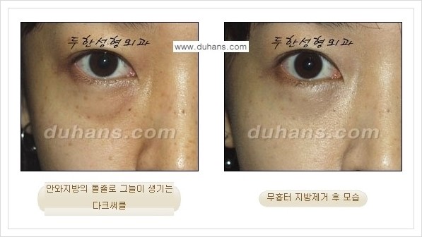 [두한성형외과 경쟁력 안검성형] - [눈밑 지방제거 안내] 관련 이미지 9