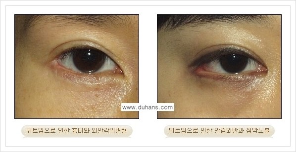 [두한성형외과 경쟁력 있는 쌍꺼풀 재수술] - [뒤트임 수술] 관련 이미지 10