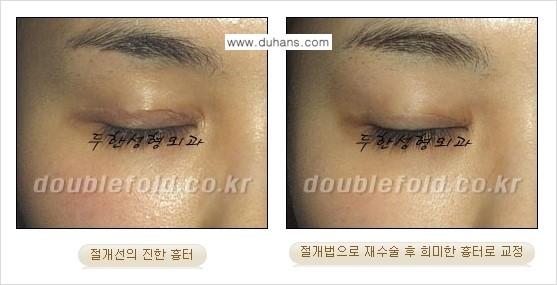 [두한성형외과 함께하는 아름다운 눈매로의 변신] - [흉터선이 진한 경우] 관련 이미지 7