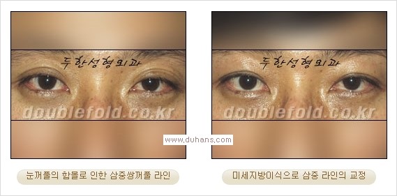 ​⁠⁠[두한성형외과 경쟁력 쌍꺼풀 재수술, 극한 눈재수술] - [지방이식으로 눈매와 쌍꺼풀 라인을 교정] 관련 이미지 19