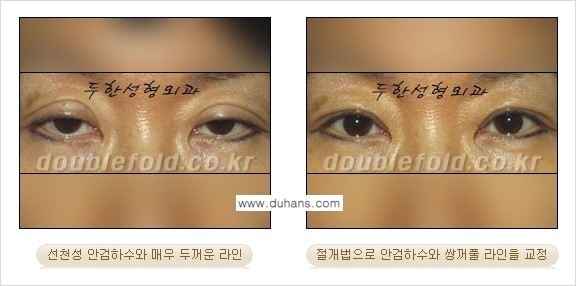 [두한성형외과 NO.1 "극한 눈(쌍꺼풀 재수술)"] - [안검하수(졸린눈매) 재수술 안내 3.] 관련 이미지 8