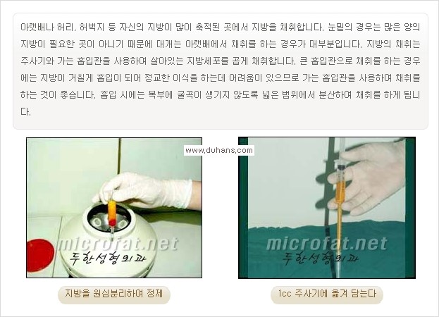 [두한성형외과 경쟁력 눈밑성형] - [눈밑 애교살 시술을 위한 미세지방이식] 관련 이미지 4