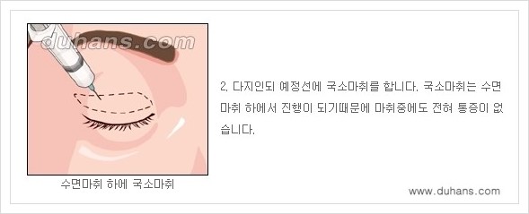 [두한성형외과 경쟁력 눈성형] - [상큼하고 환한 눈매! 상안검 성형(윗눈꺼풀 처짐) 안내] 관련 이미지 2