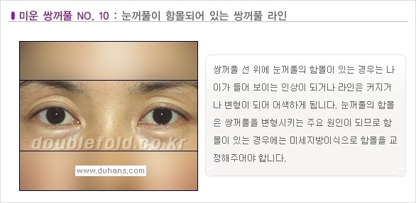 [두한성형외과 경쟁력 눈성형] - [나에게 맞는 맞춤 쌍꺼풀 찾기] 관련 이미지 10