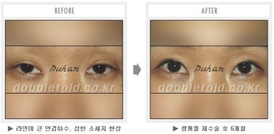 두한성형외과 쌍커풀 재수술 - 짝눈 눈매교정, 가성 안검하수 교정과 뒤밑트임 관련 이미지 46
