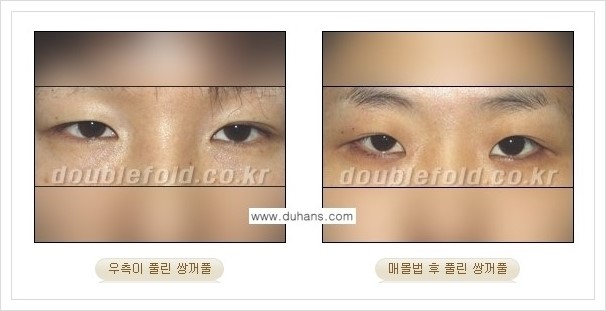 [두한성형외과 경쟁력 쌍꺼풀 재수술(극한 재수술)] - [라인이 풀렸을 경우의 쌍꺼풀 재수술 안내 ②] 관련 이미지 1